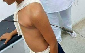 Menino sobrevive a espeto no coração.